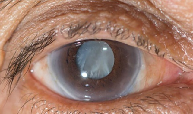 If you have a "secondary cataract," what do you do?
