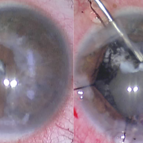 Can You Get a Cataract After Cataract Surgery?
