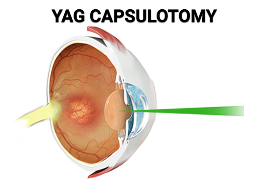 Infections Caused by YAG Laser Capsulotomy
